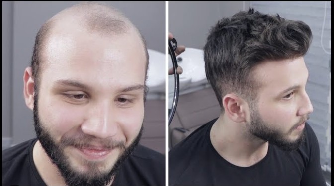 Doğal Görünümlü Saçlara Kavuşmanın En Kolay Yolu: Protez Saç Nedir, Nasıl Uygulanır?